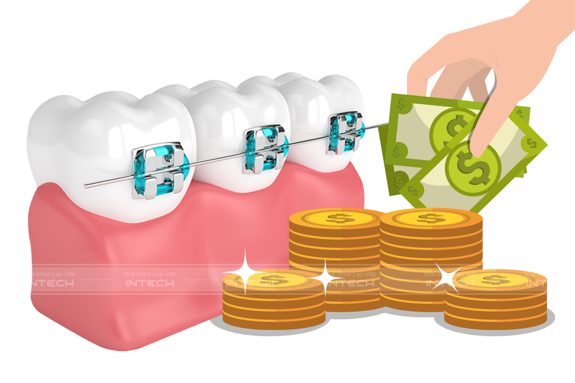 giá niềng răng rẻ nhất