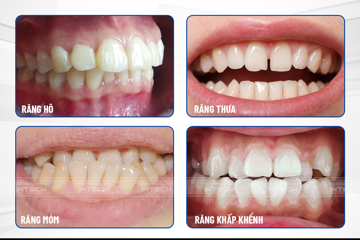 niềng răng rẻ nhất
