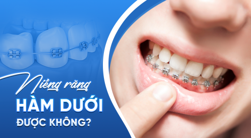 Niềng răng hàm dưới có được không? Giá bao nhiêu? Hiệu quả như thế nào?