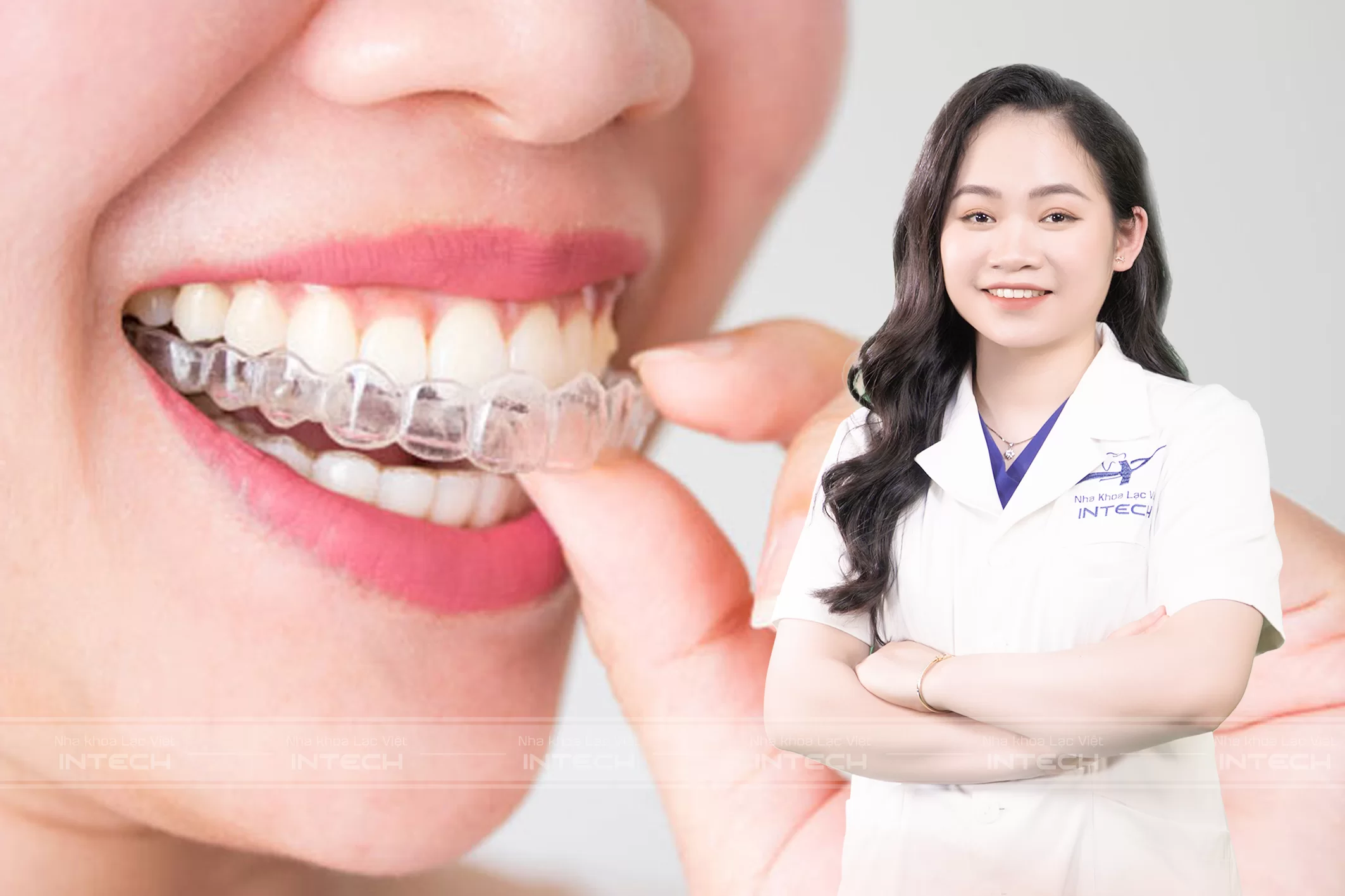 Niềng răng trong suốt Invisalign