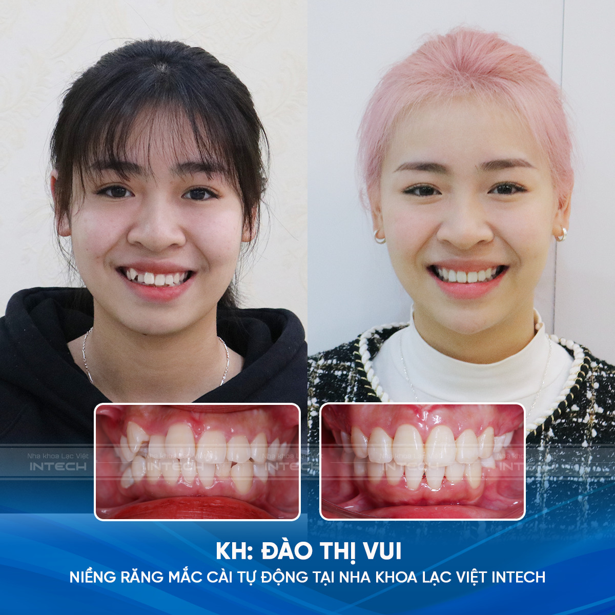 Khách hàng Đào Thị Vui trước và sau niềng răng khấp khểnh tại Nha khoa Lạc Việt Intech