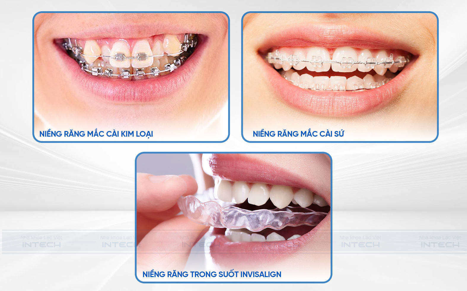 Các phương pháp niềng răng khấp khểnh