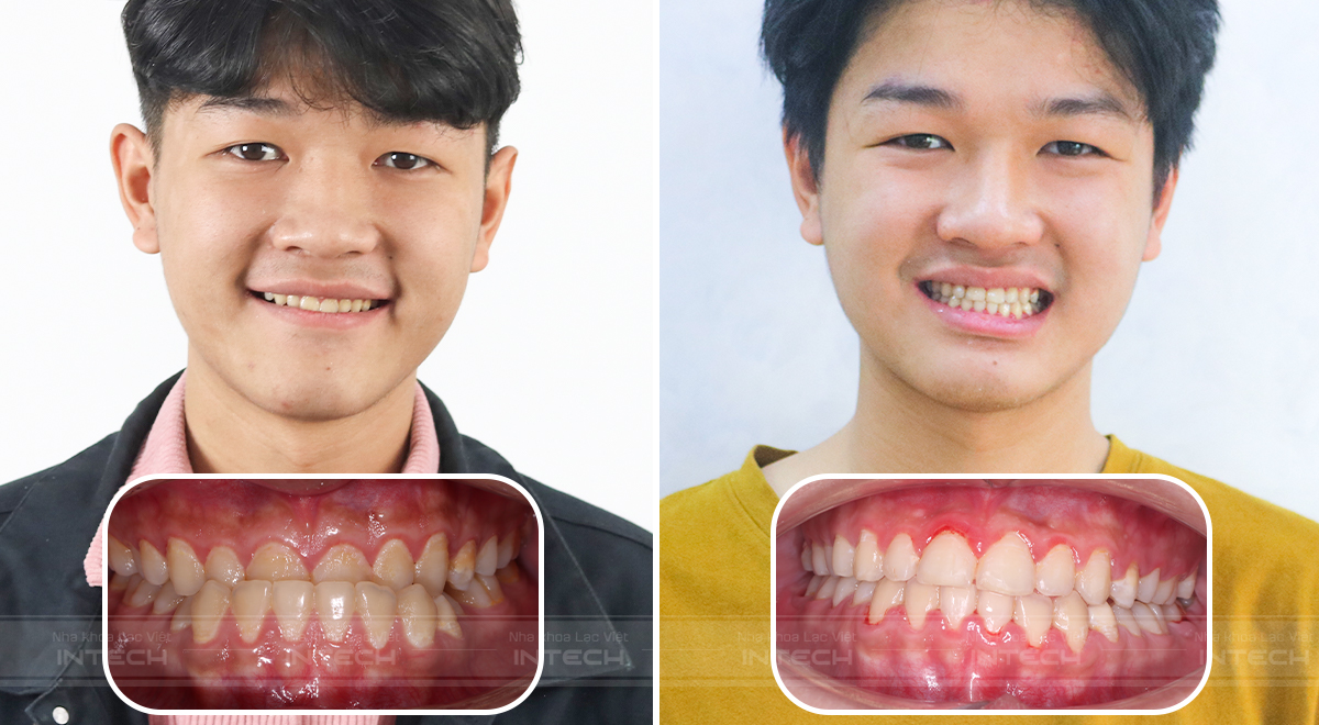 Niềng răng cải thiện khớp cắn ngược 