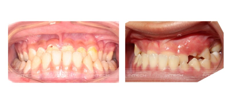 niềng răng khớp cắn ngược