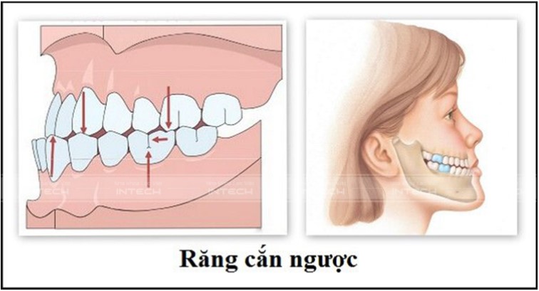 quy trình niềng răng khớp cắn ngược