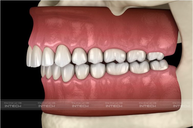 khớp cắn sâu có niềng được không