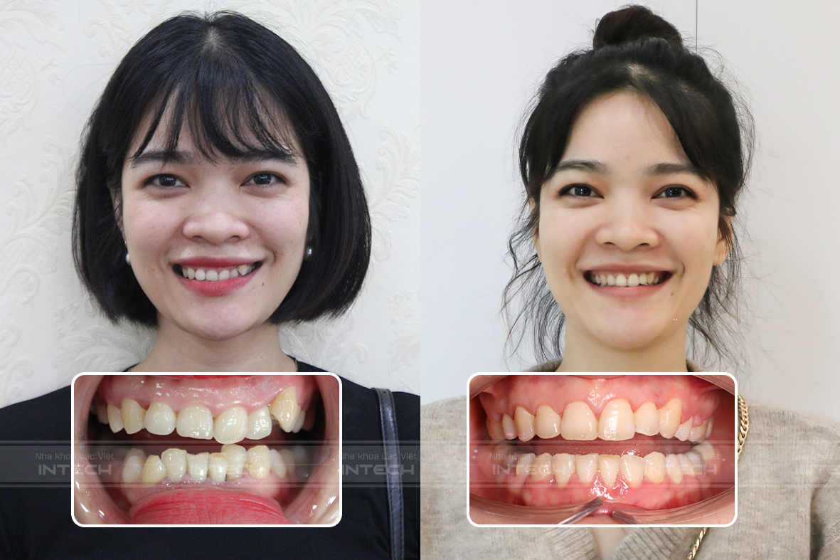 niềng răng khớp cắn sâu