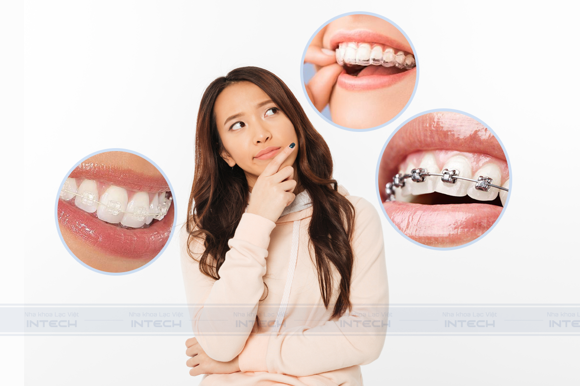 quy trình niềng răng khớp cắn sâu