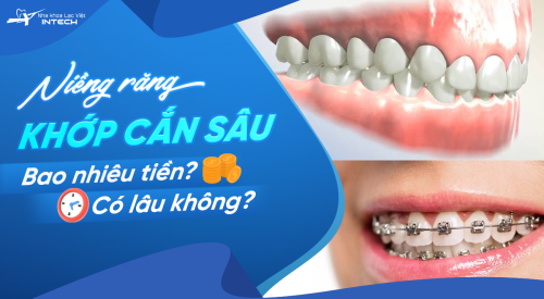 Niềng răng khớp cắn sâu có được không? Bao nhiêu tiền? Quy trình chi tiết
