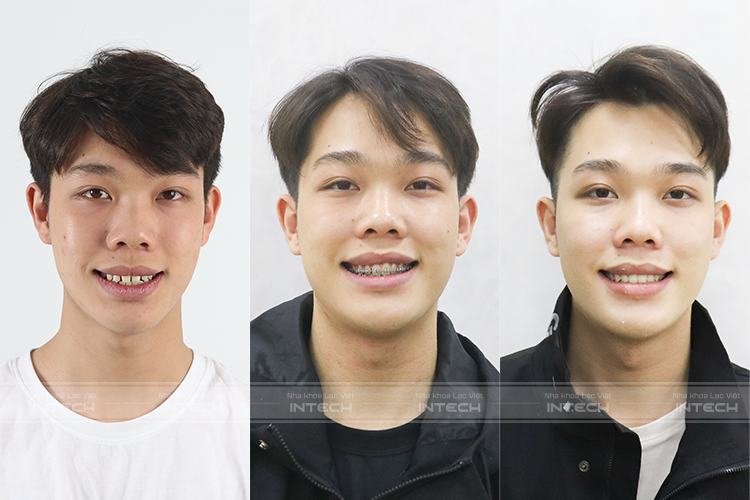 niềng mắc cài kim loại