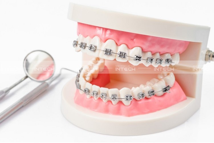 niềng răng mắc cài kim loại