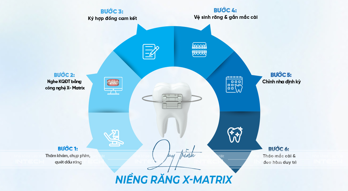 quy trình niềng răng mắc cài kim loại