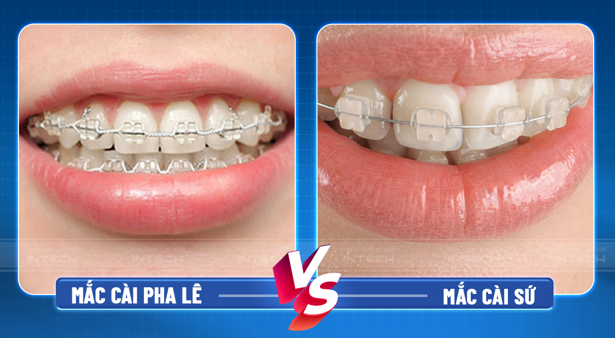 niềng răng mắc cài pha lê