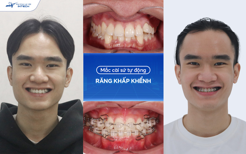 Niềng răng khấp khểnh tại Lạc Việt Intech