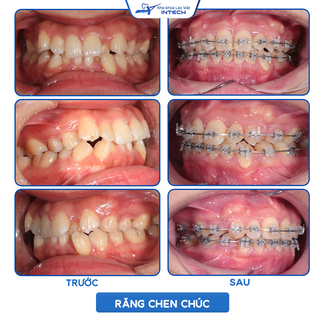 Niềng răng chen chúc bằng mắc cài sứ