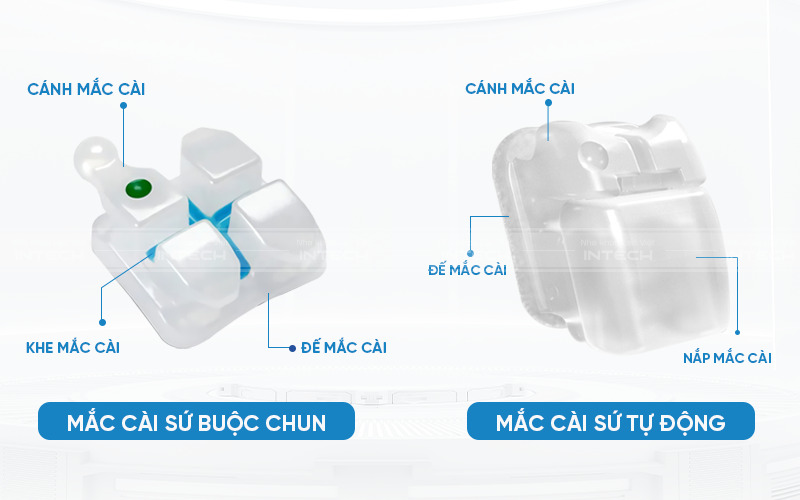 Mắc cài sứ