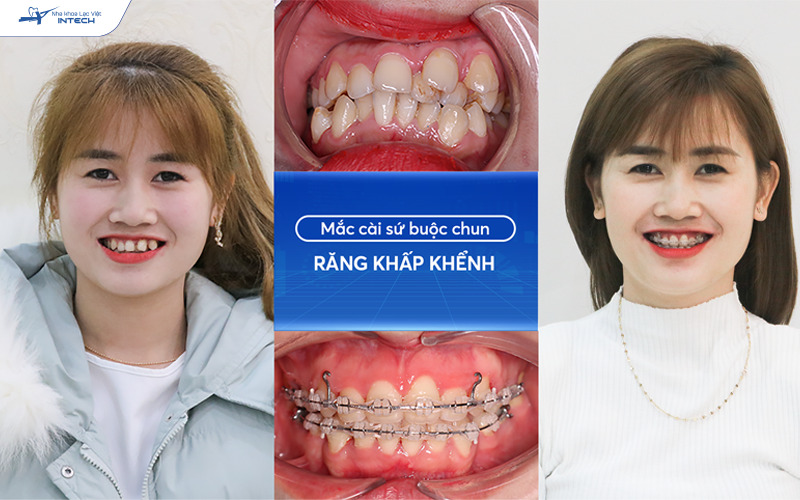 Niềng răng khấp khểnh tại Lạc Việt Intech