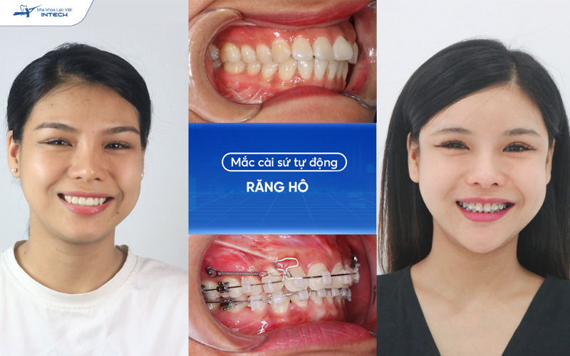 Trước sau niềng răng hô tại Lạc Việt Intech