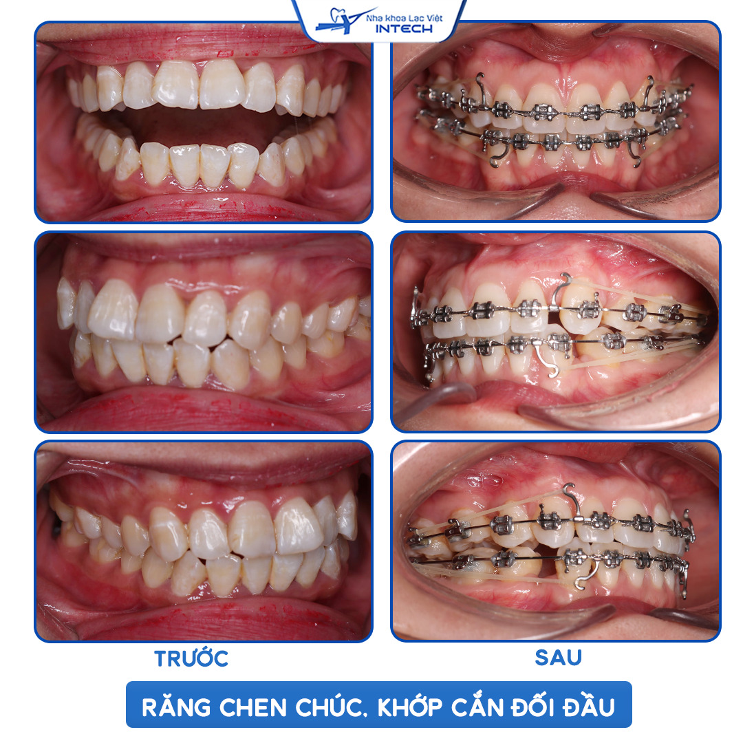 Niềng răng mắc cài kim loại khắc phục răng chen chúc, khớp cắn đối đầu