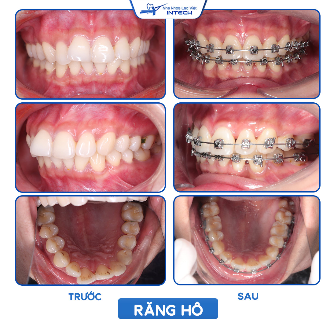 Lưu ý khi niềng răng hô 