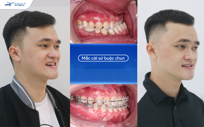 Niềng răng mắc cài sứ khắc phục tình trạng răng móm