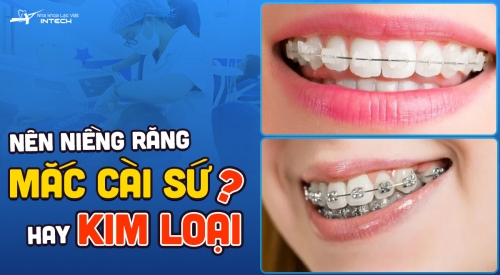 Bật mí: Nên niềng răng mắc cài sứ hay mắc cài kim loại?