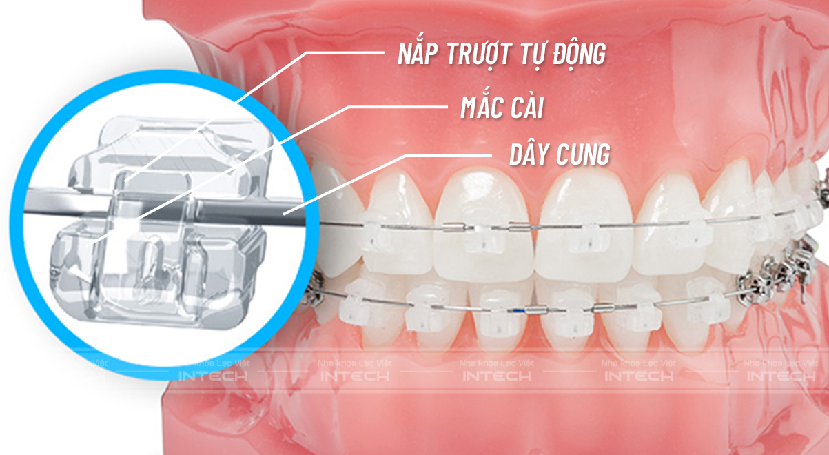 mắc cài sứ tự buộc