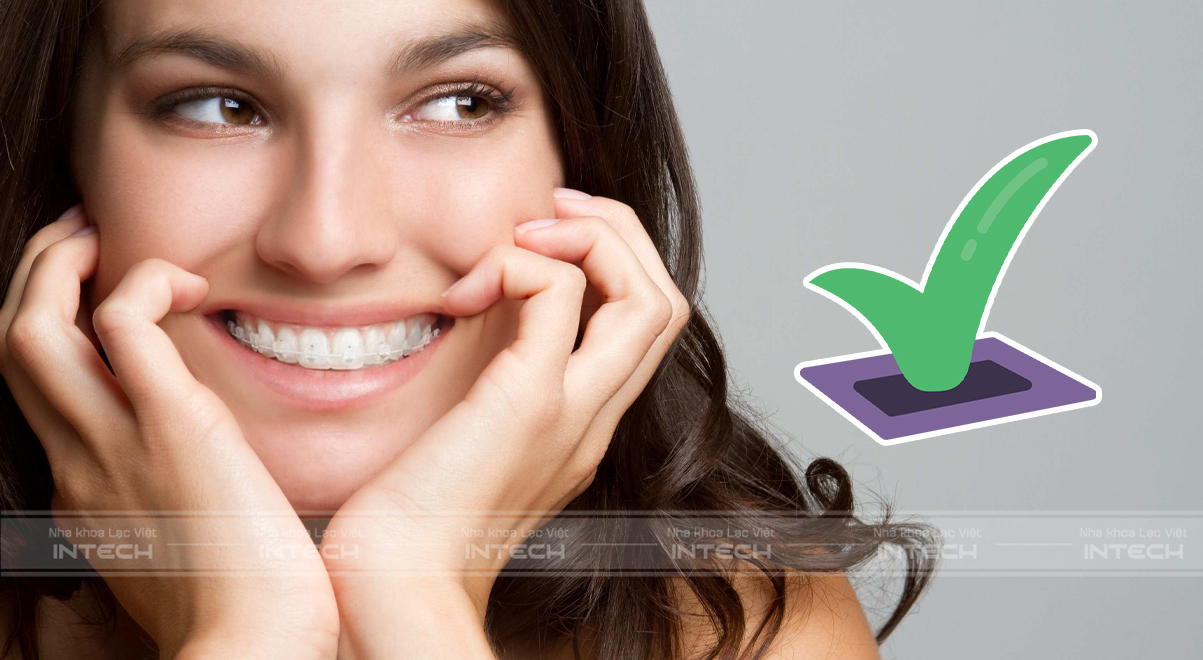 mắc cài sứ tự đóng