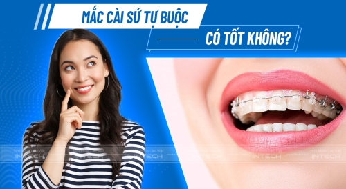 Niềng răng mắc cài sứ tự buộc là gì? Có tốt không? Giá bao nhiêu?
