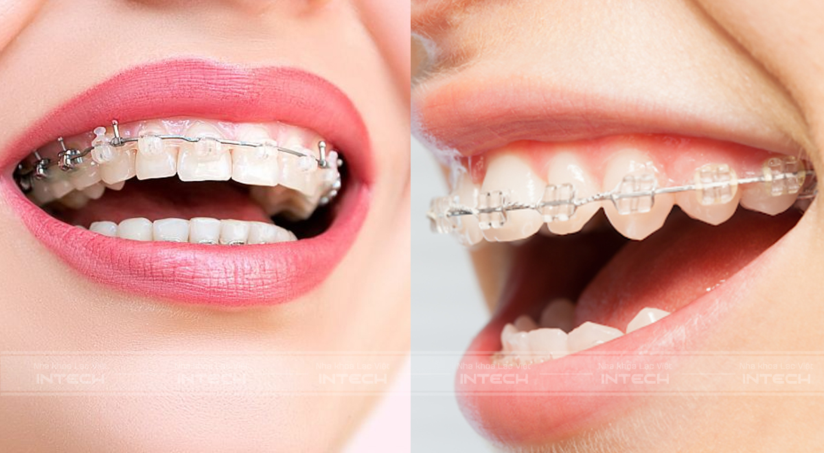niềng răng mắc cài sứ
