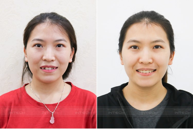niềng răng mắc cài trong suốt
