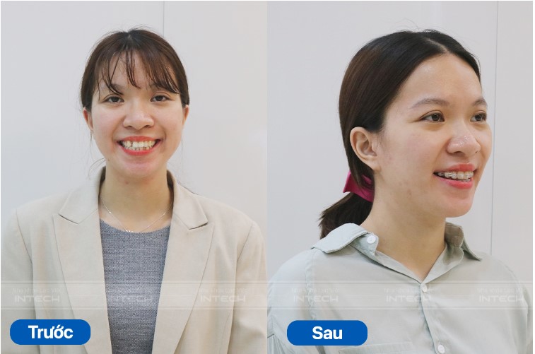 niềng răng mắc cài trong