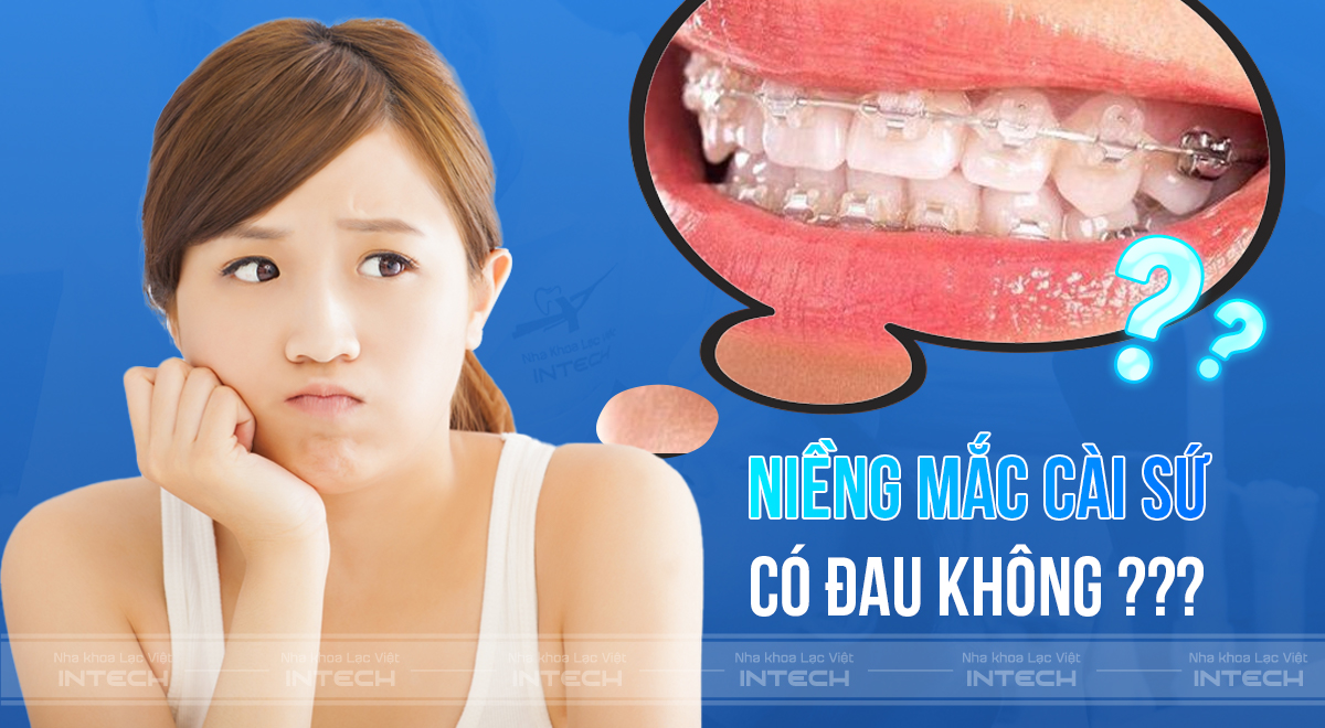 niềng răng sứ