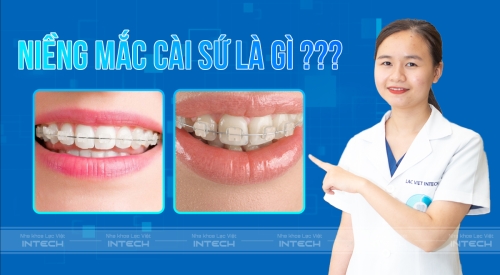 Niềng răng mắc cài sứ là gì? Có tốt không? Giá bao nhiêu?