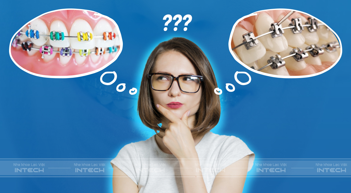 mắc cài kim loại thường và tự buộc
