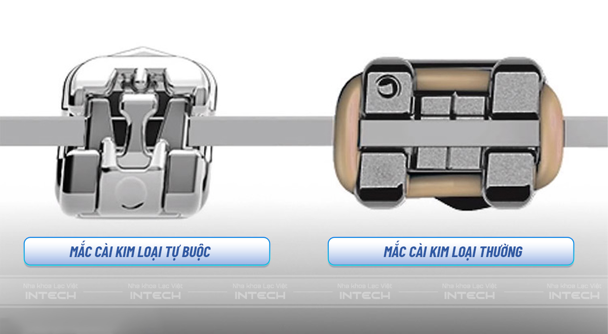 mắc cài tự buộc và mắc cài thường
