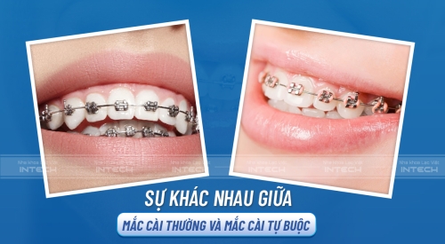 So sánh niềng răng mắc cài kim loại thường và niềng răng mắc cài tự buộc