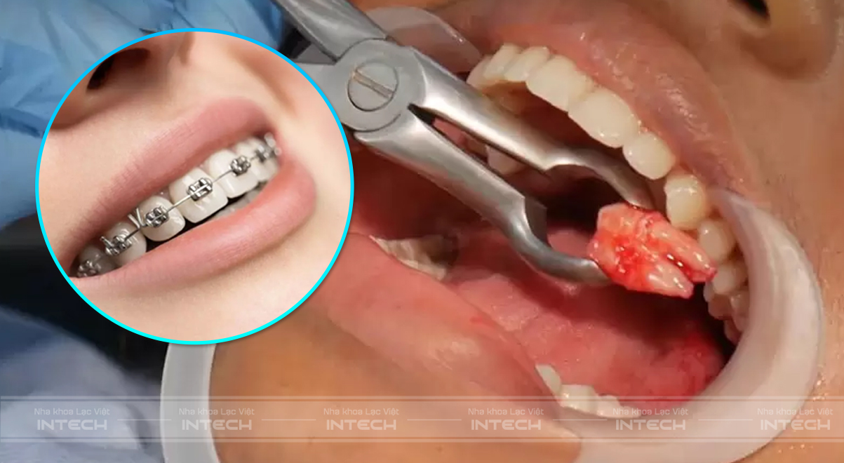 mắc cài kim loại tự buộc
