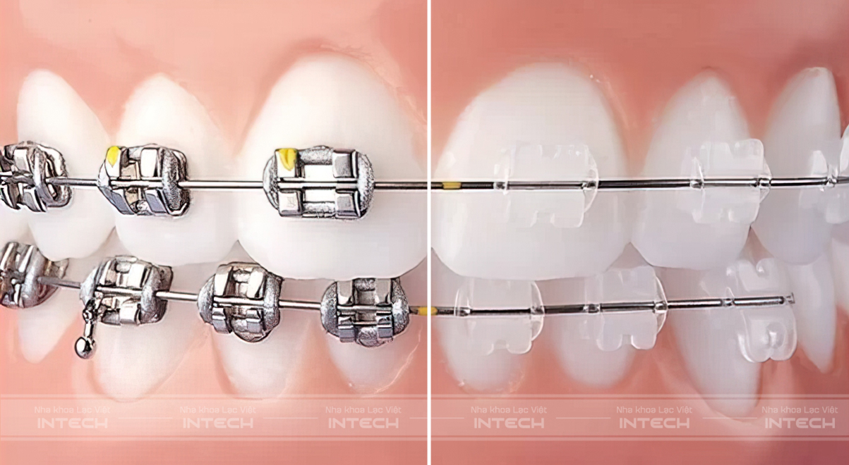 mắc cài tự đóng