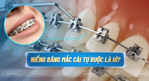 Niềng răng mắc cài tự buộc là gì? Có tốt không? Nên dùng kim loại hay sứ?