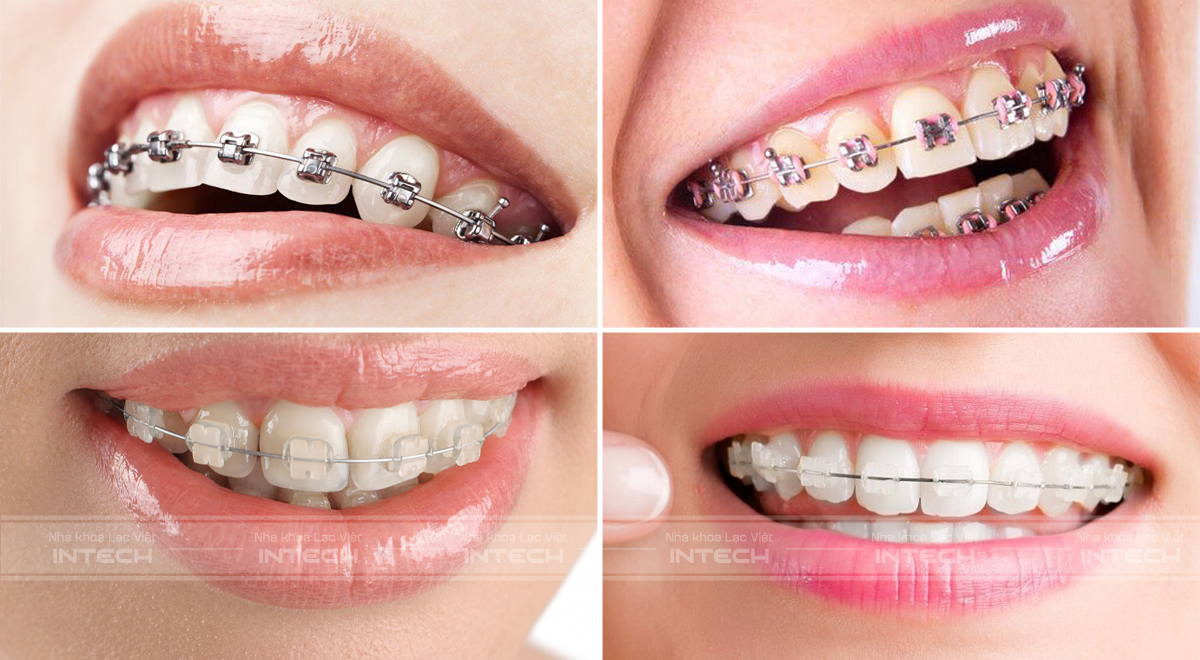 các loại mắc cài niềng răng