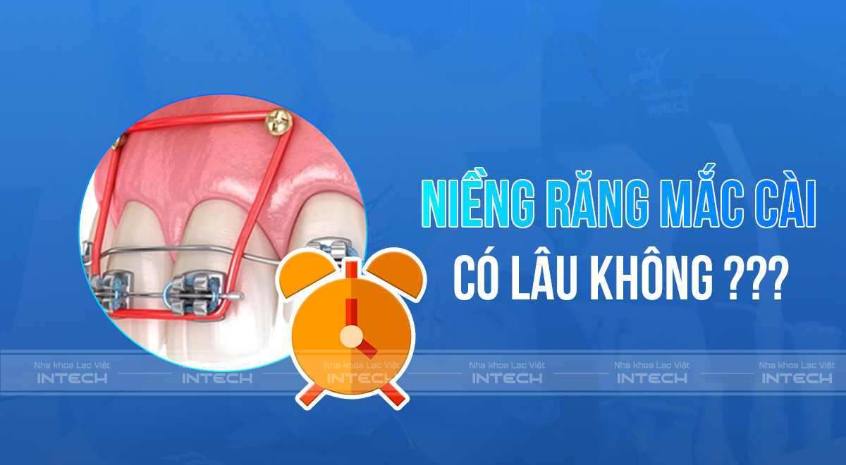 chỉnh nha mắc cài