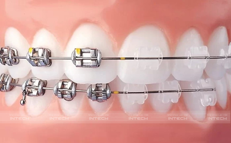 niềng răng mắc cài