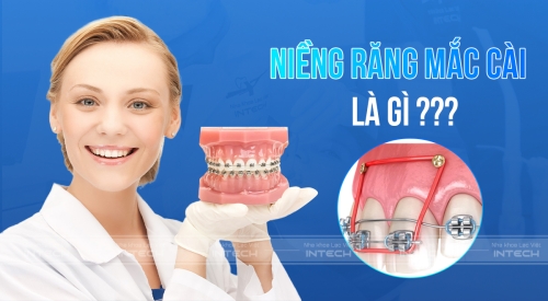 Niềng răng mắc cài là gì? Giá bao nhiêu? Phân biệt các loại mắc cài