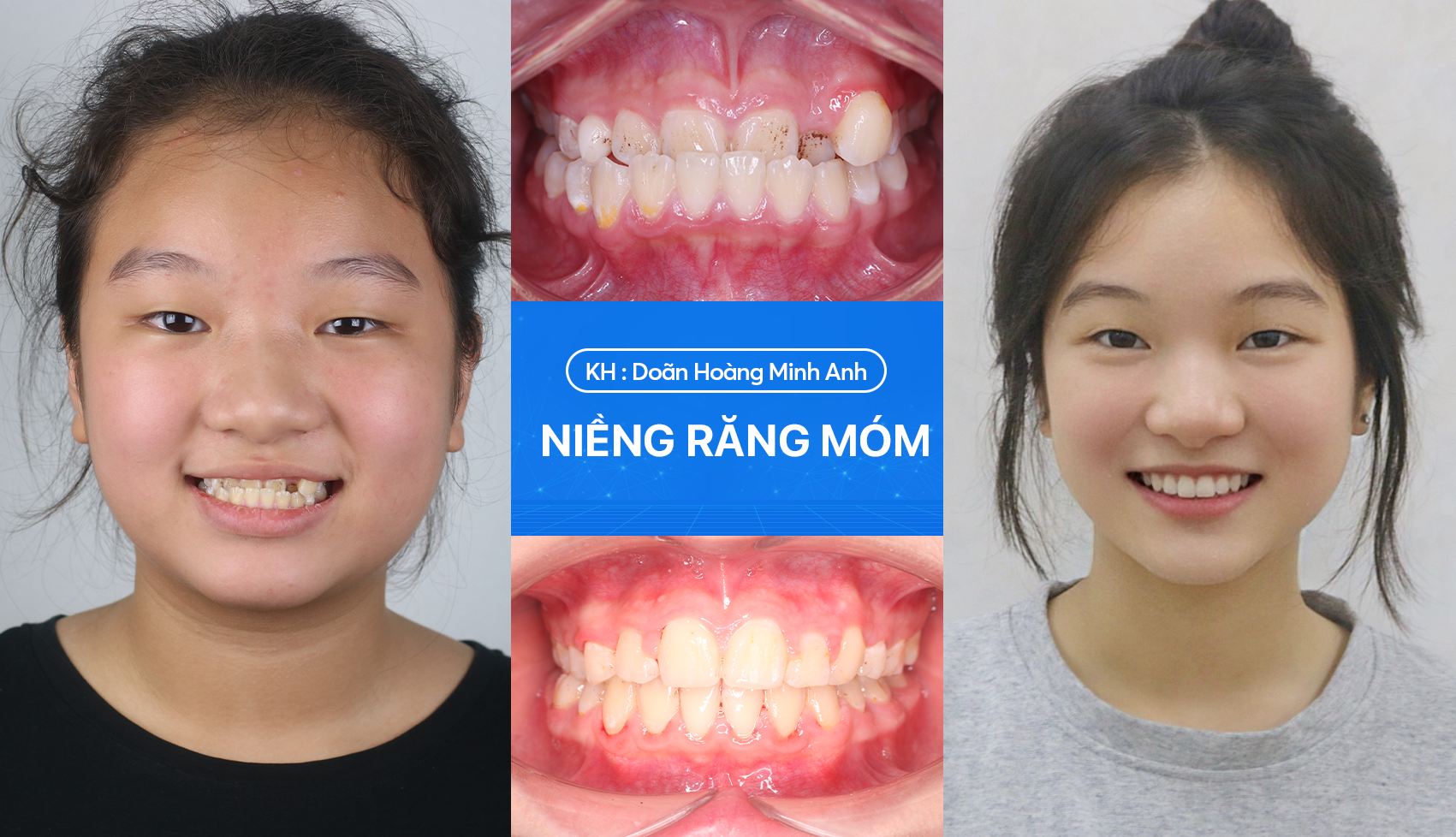 Niềng răng móm trẻ em 