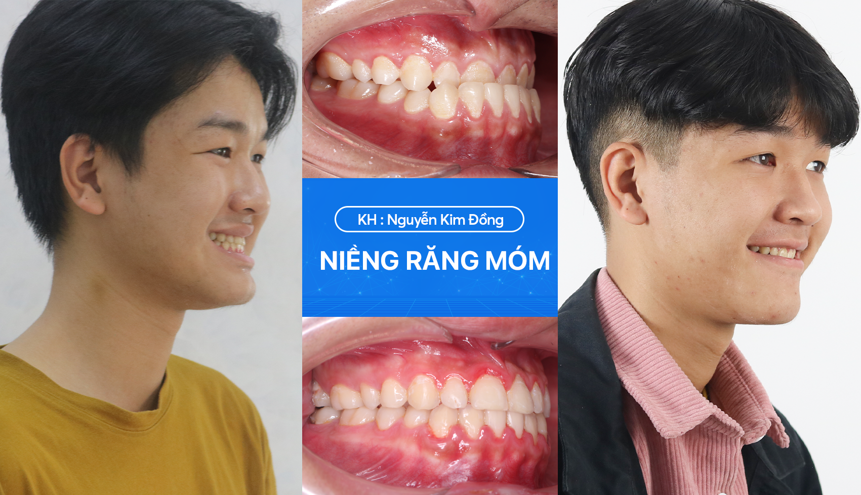 Răng móm thay đổi như thế nào 