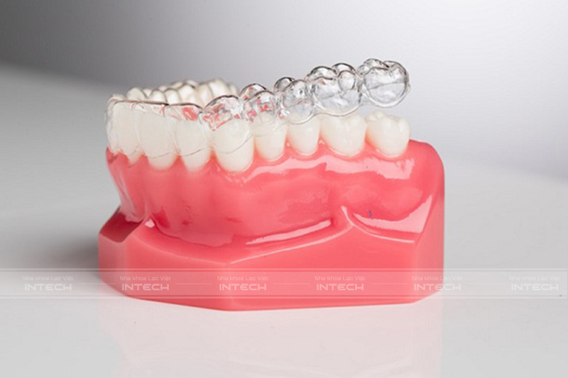bị móm có nên niềng răng