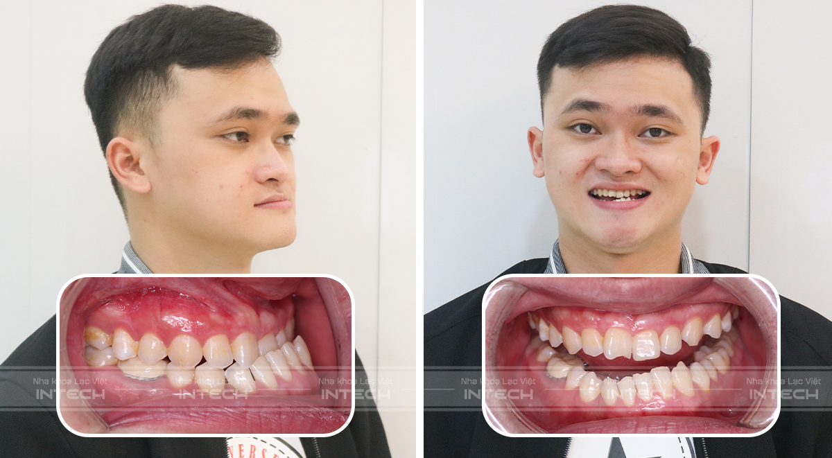 niềng răng móm bao nhiêu tiền