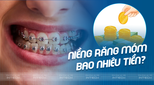 Niềng răng móm bao nhiêu tiền? Trong bao lâu? Có hiệu quả không? 