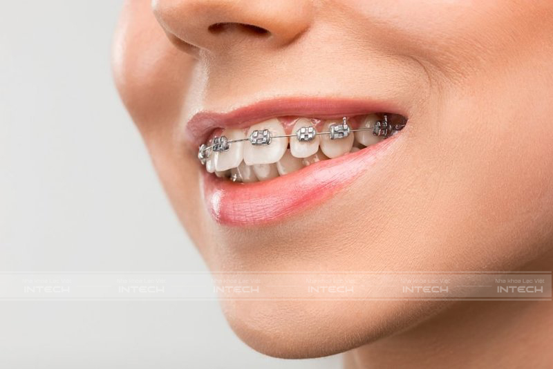 niềng răng một hàm giá bao nhiêu